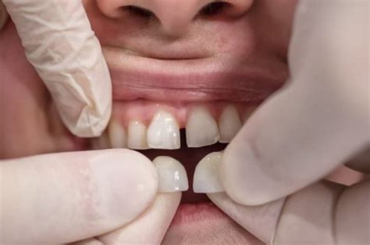 How much do Lumineers cost per tooth?